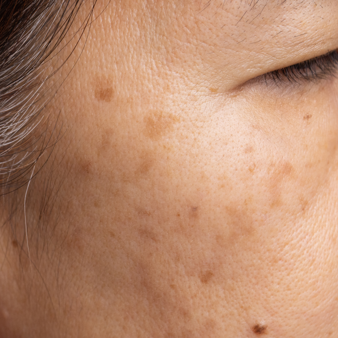 Comprender el melasma durante el embarazo: causas, prevención y tratamiento