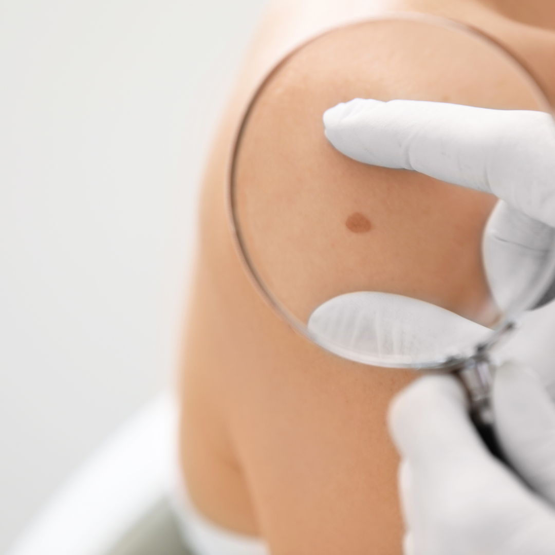 Desmentir mitos comunes sobre el cáncer de piel